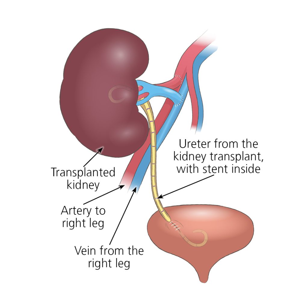 Kidney Transplant Surgery Dubai